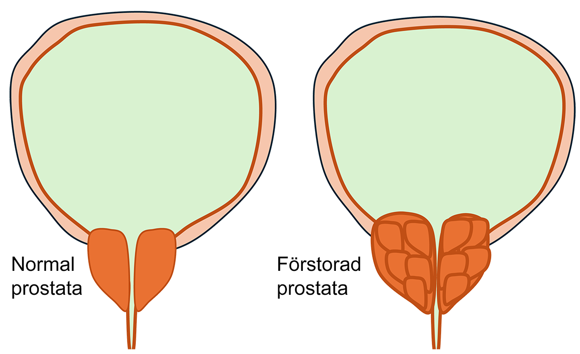 godartad prostataförstoring och förstorad prostata illustration